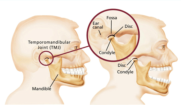 TMJ disorder 측두하악 관절 장애